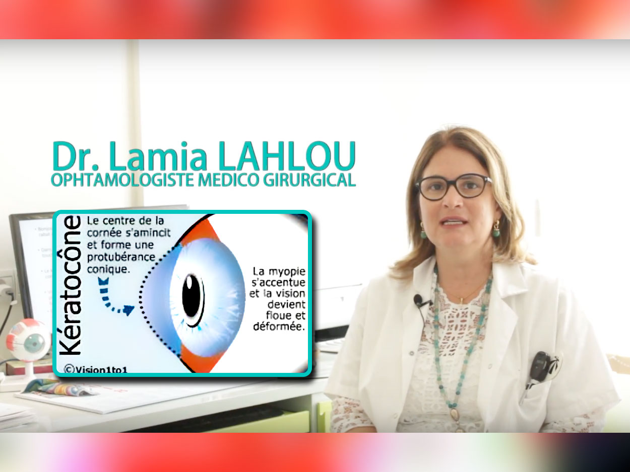 Dr LAHLOU Lamia: Le kératocône maladie des yeux qui touche les jeunes